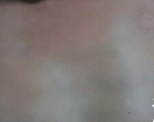 白癜风在初期症状是什么样子的