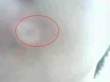 婴儿白癜风什么时辰治疗下场好
