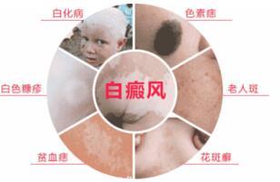 解析平易近间治疗白癜风偏方