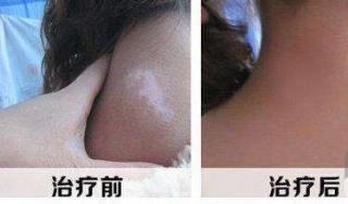 从临床病例看心里安康与白癜风的治疗