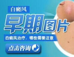 白癜风发病在面部治疗好要若干好多钱
