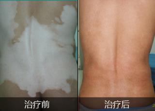脸上有白癜风 是不是要治