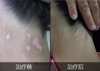 白癜风前期症状有哪些