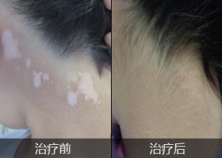 白癜风有何模范症状
