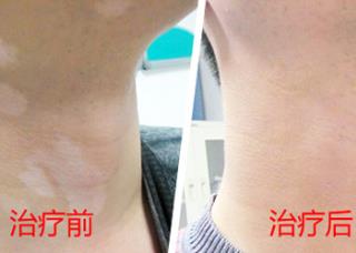 白癜风一切的详细症状是什么
