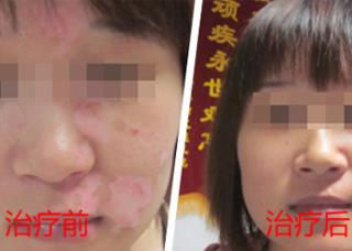 白癜风痒