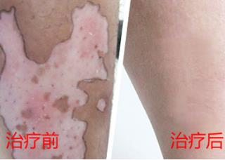 白叟脸上的白斑是白癜风吗