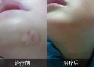 日经常糊口中白癜风患者须要忌口吗