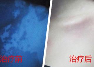 脸上嘴角边长白斑是怎样回事