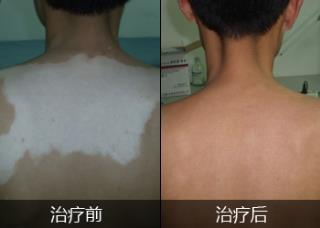 白癜风先兆