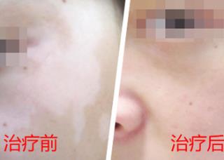 成人突发白癜风是什么缘由
