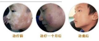 河北哪个医院治疗白癜风最专业
