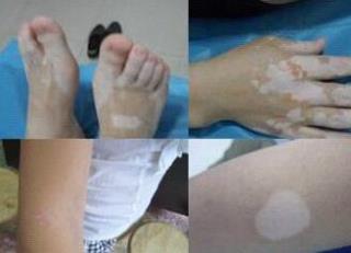 黑色素细胞增添易得白癜风