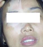让我们来看看往经常型白癜风怎样去区分吧！