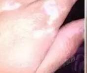 白癜风损伤处瘙痒的缘由是什么