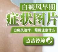 河北白癜风有什么临床表现症状