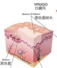 河北大型治疗白癜风的中医院