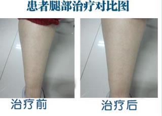 白癜风是种什么病啊