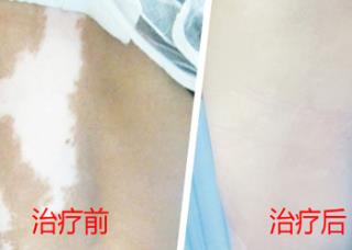 河北哪的白癜风医院好