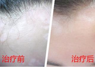 白癜风为什么治疗难