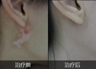 白癜风什么症状是属于早期的