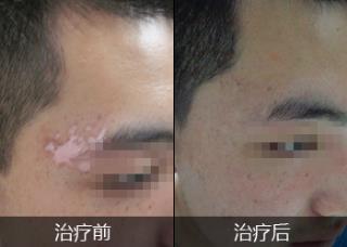 河北哪家白癜风医院装备激进
