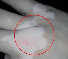 白癜风早期的症状是什么样子的