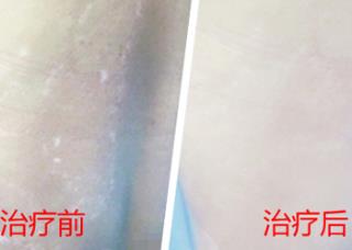 白癜风稳按期症状有哪些