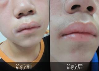 白癜风先兆症状有哪些呢