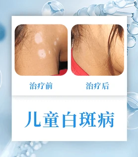 白癜风白斑病