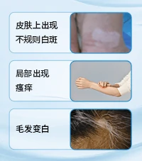 白癜风白斑病常识