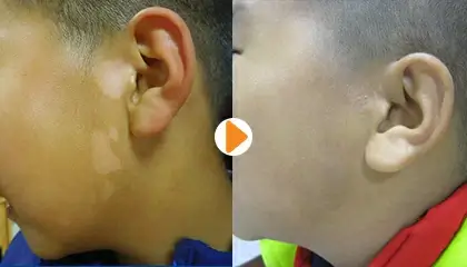 刘惠莉医生白癜风治疗案例3