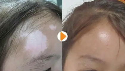 李洪燕医生白癜风治疗案例3