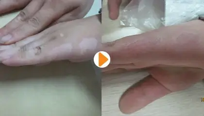 王明峰医生白癜风治疗案例3