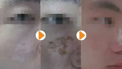 王树申医生白癜风治疗案例3